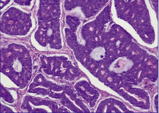 Adenoid Cystic Carcinoma Of The External Auditory A Case Report